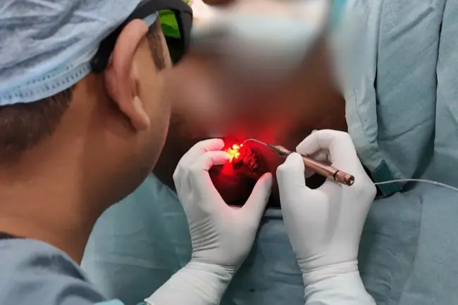 Laser Fistula Surgery