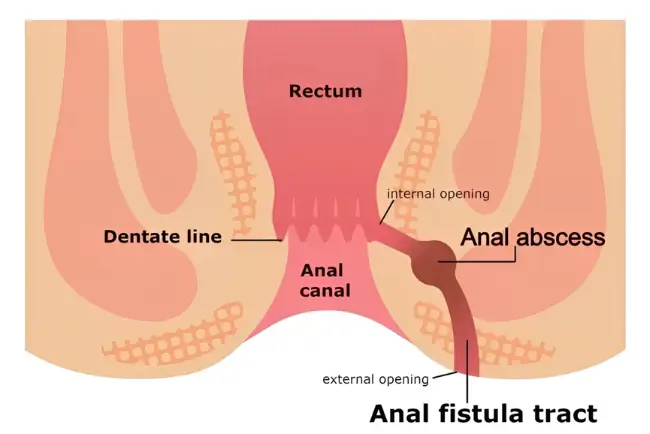 Open Fistula Surgery